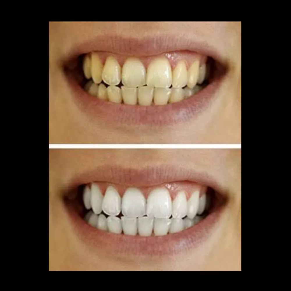 33235 at home whitening kits