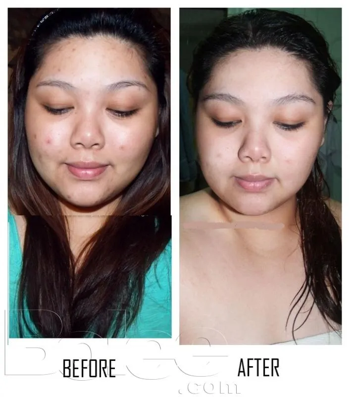 33236 skin whitening surgery bangalore before after