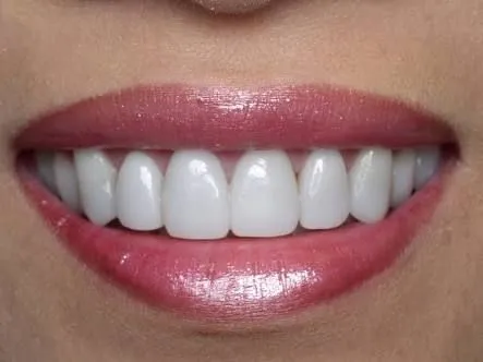 33237 teeth whitening west hollywood image5