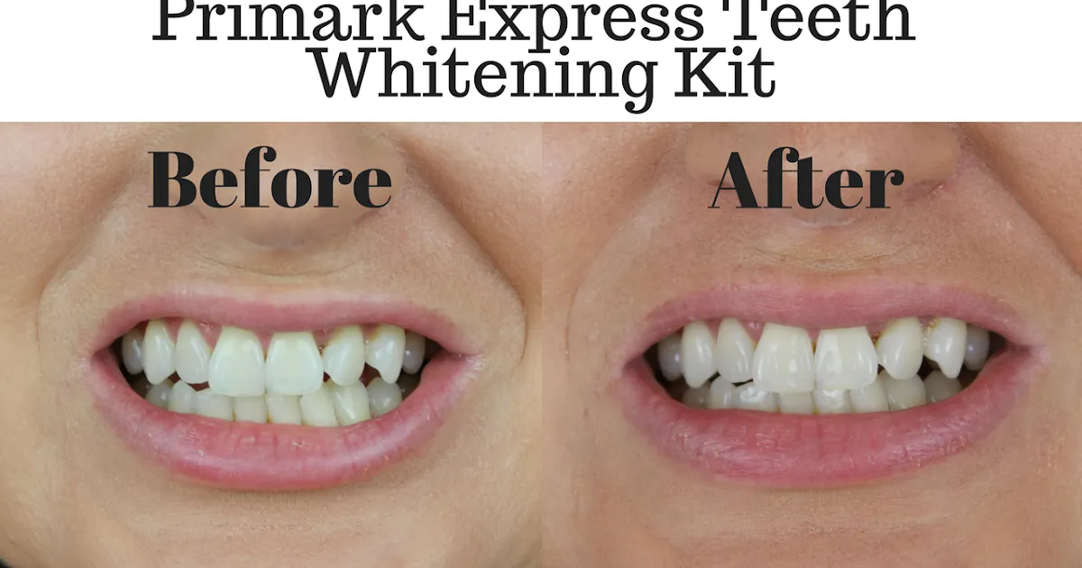 33237 teeth whitening west hollywood image6