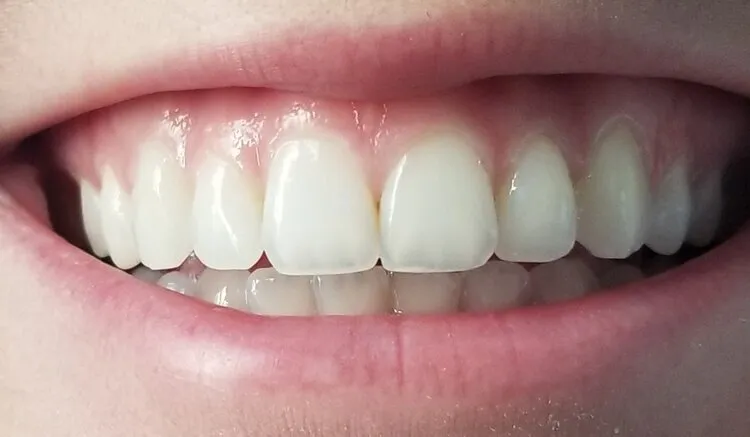 33238 teeth whitening az before after