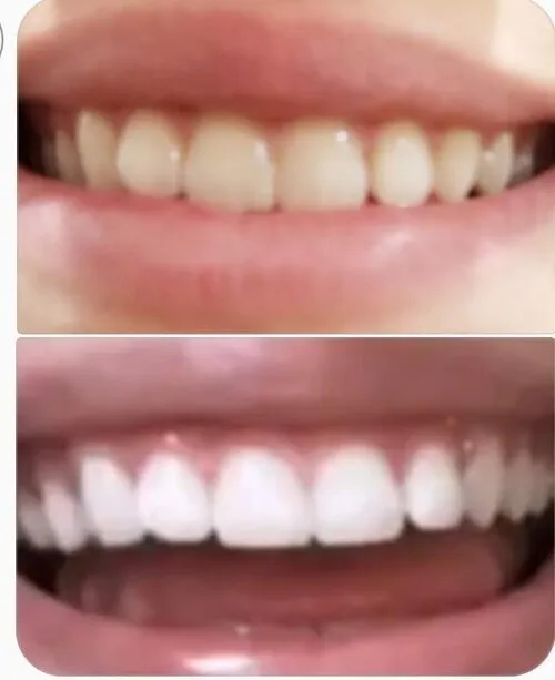 33238 teeth whitening az sensitive teeth