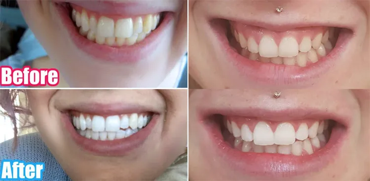 33246 teeth whitening coffee