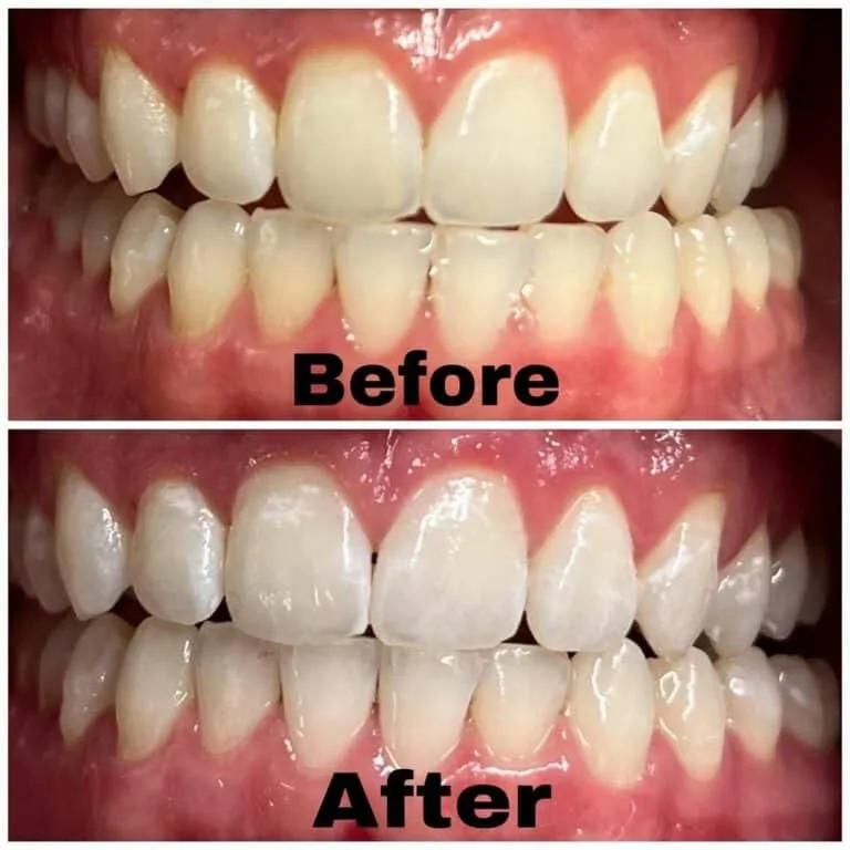 33251 teeth whitening pasadena 4