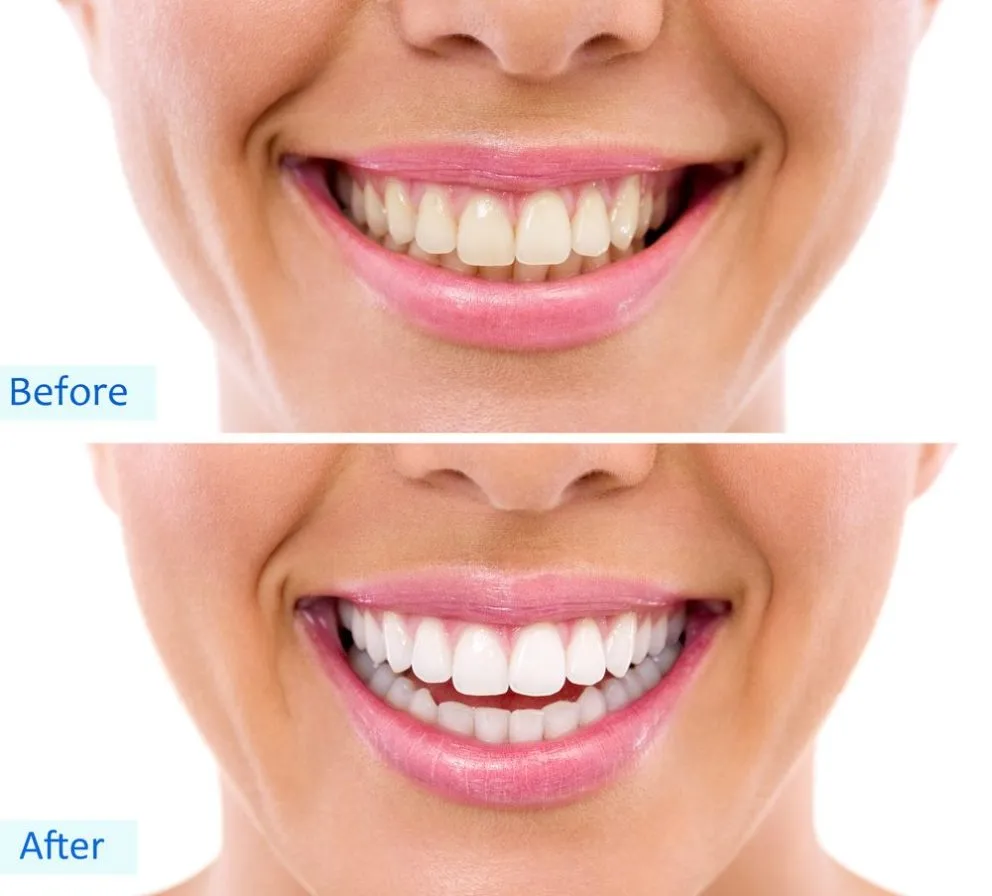 33257 teeth whitening methods