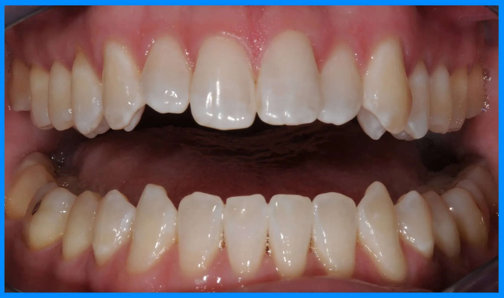 33258 zoom whitening nyc before after