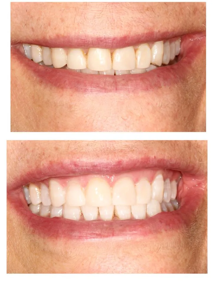 33258 zoom whitening nyc dentist