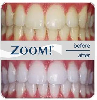 33258 zoom whitening nyc patient