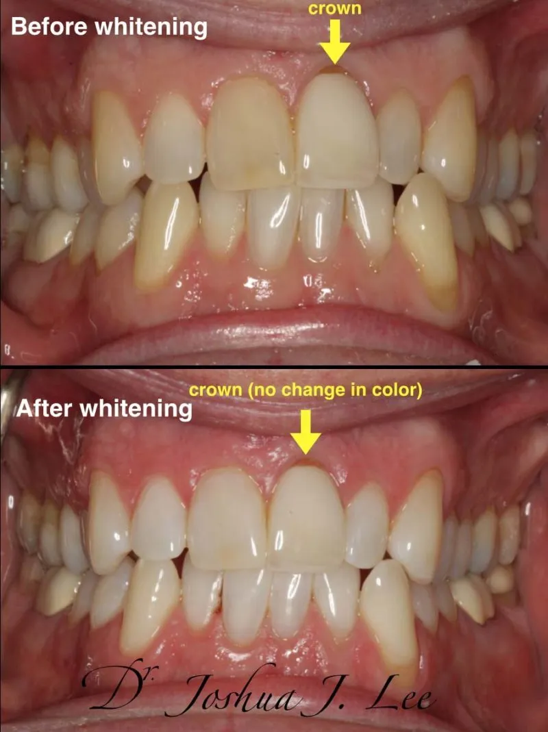 33258 zoom whitening nyc procedure
