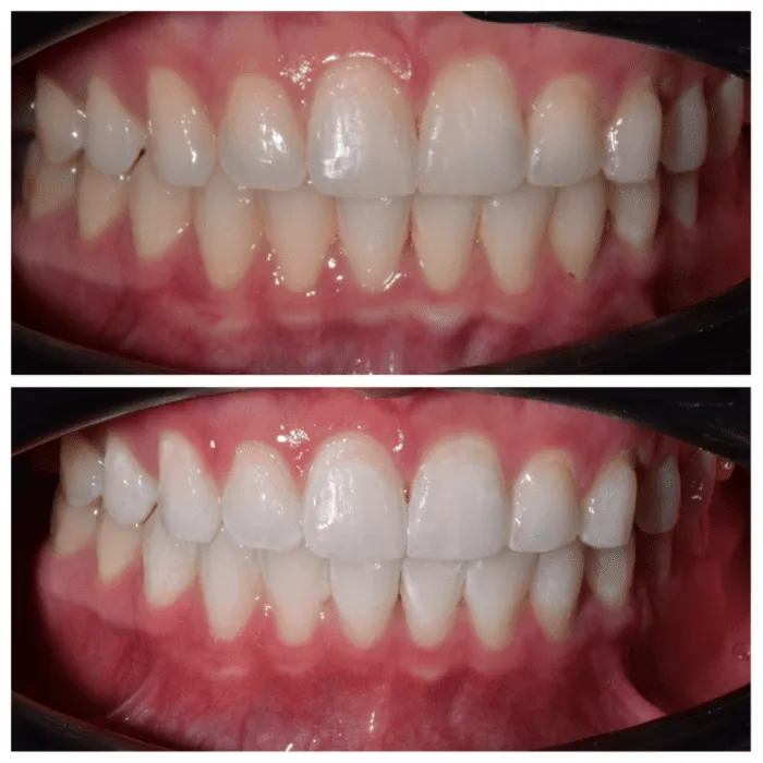 33258 zoom whitening nyc teeth