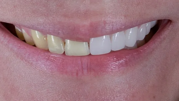 33259 teeth whitening tijuana maintenance