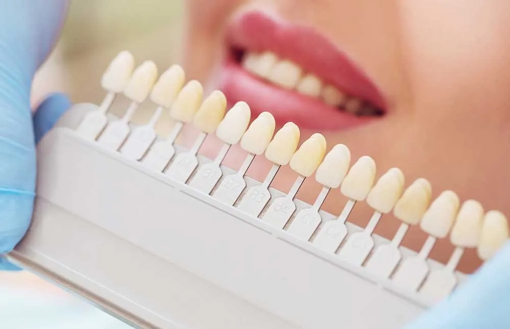 /img/33262-veneers-lifespan-whitening.webp