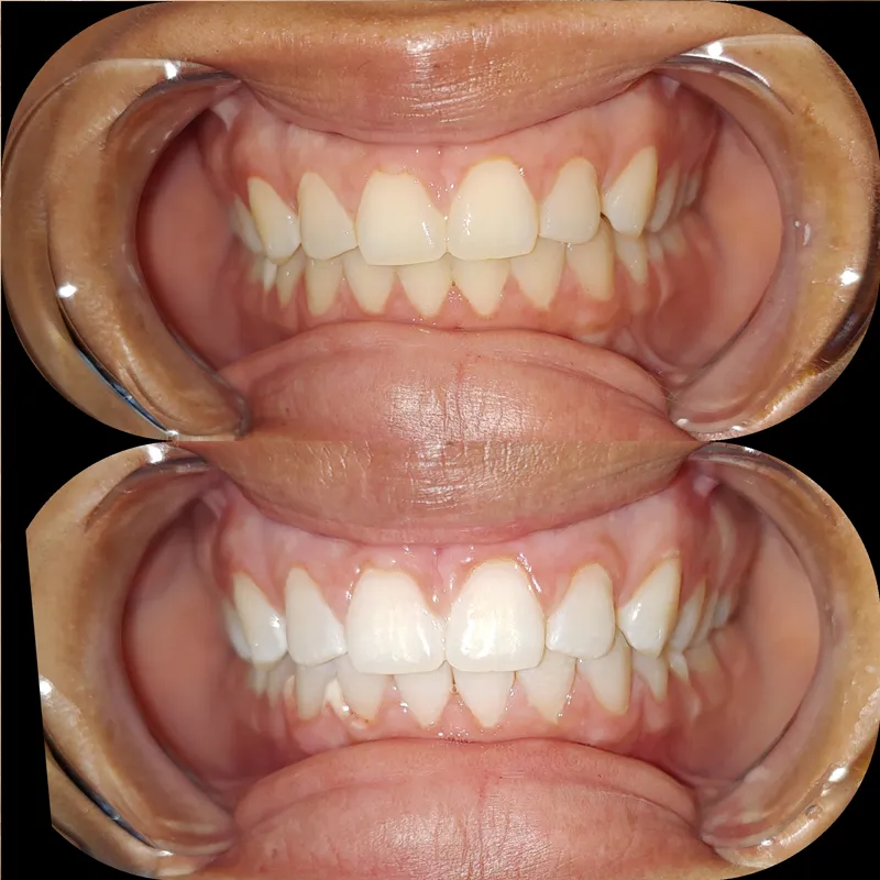 33264 teeth whitening at home kits