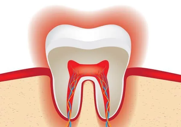 33265 sensitive teeth whitening 3