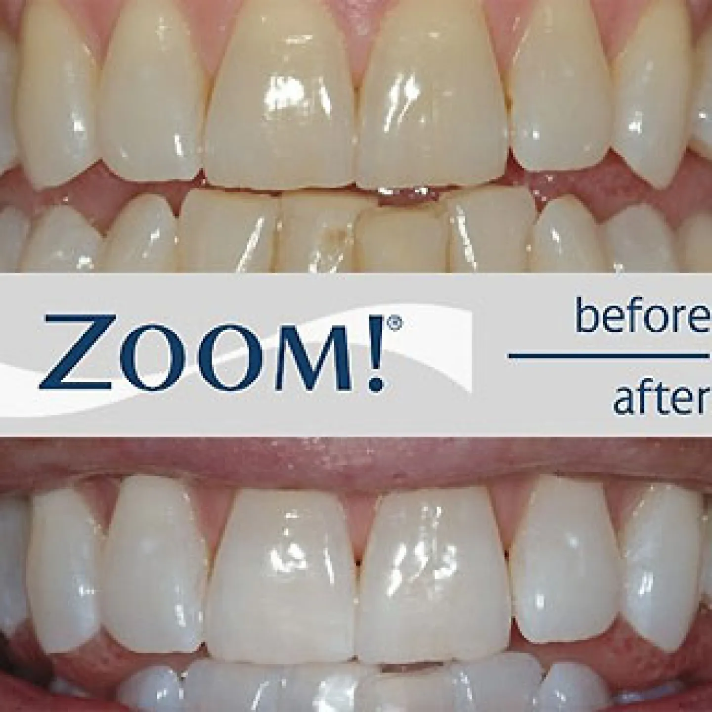 33272 zoom teeth whitening patient