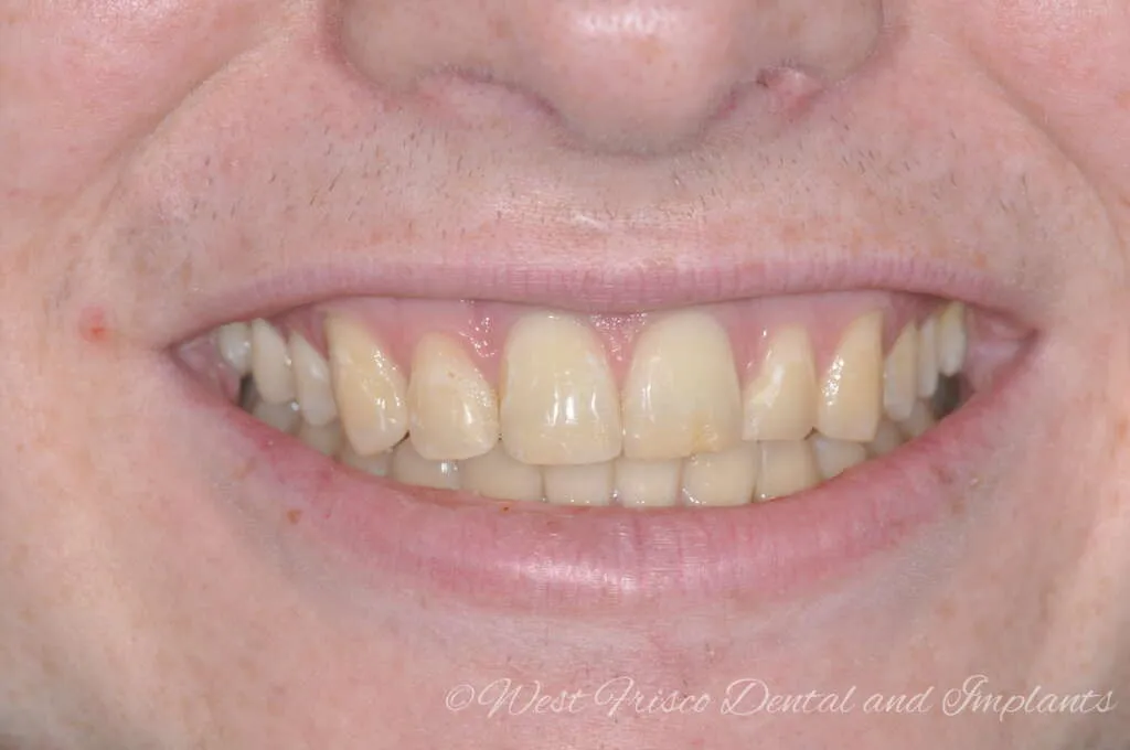 33272 zoom teeth whitening procedure