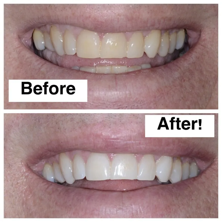 33272 zoom teeth whitening results