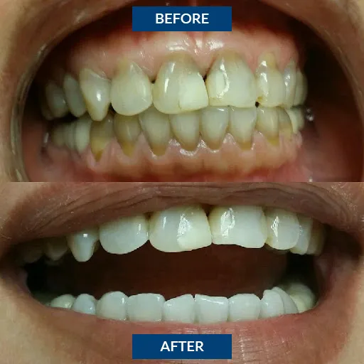 33275 teeth whitening refill options