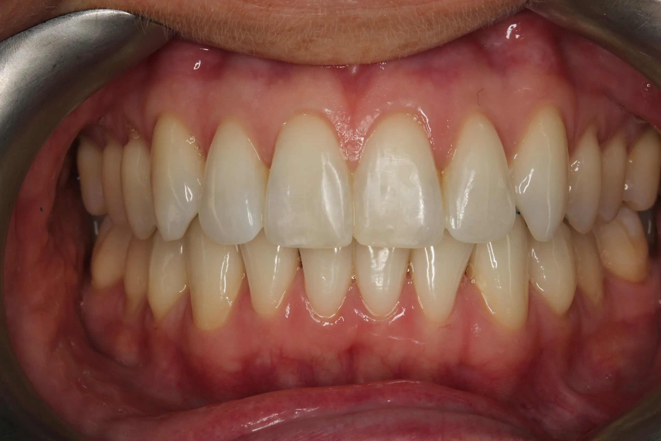 33276 professional teeth whitening