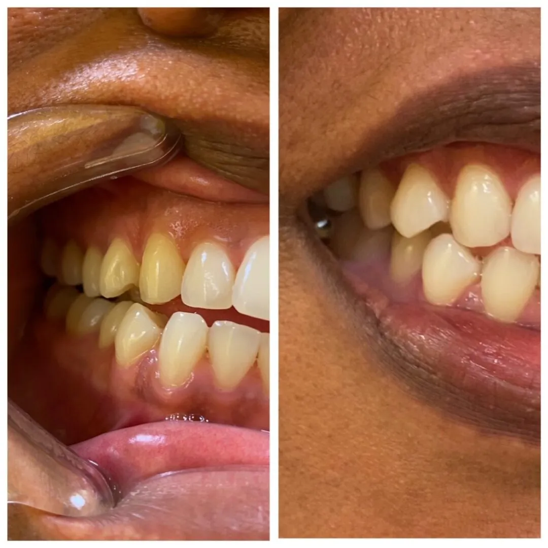 33277 tooth discoloration