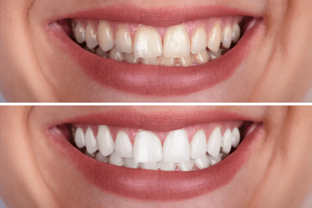 33289 teeth whitening smile
