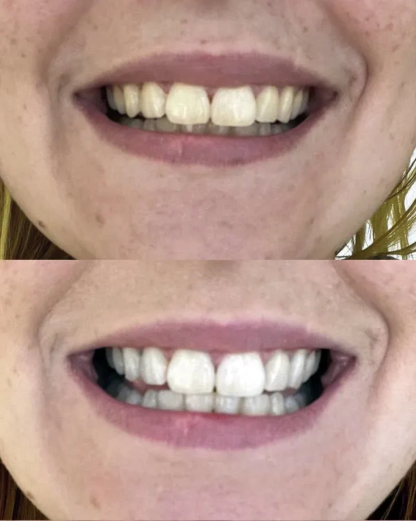 33294 teeth whitening results