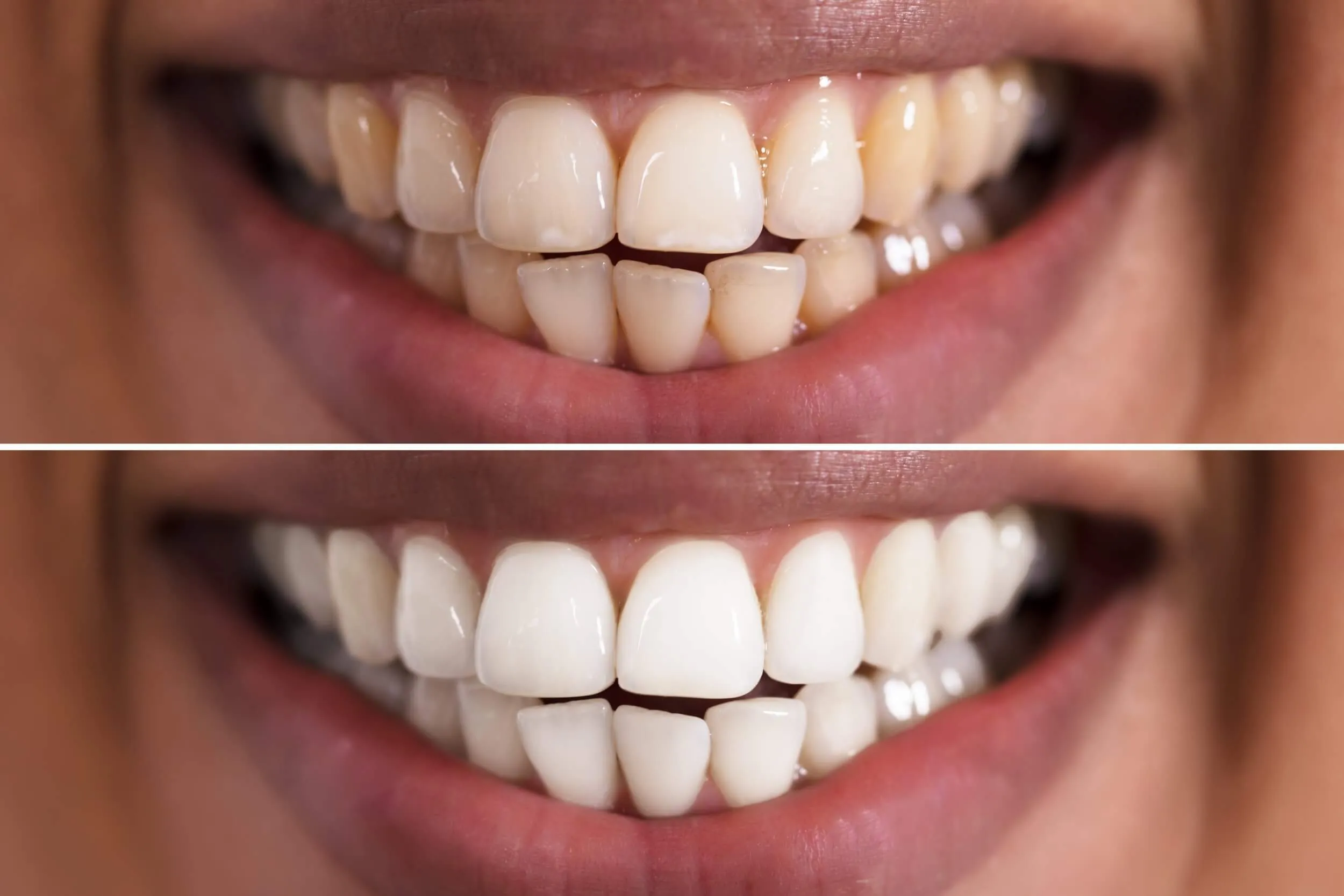 33307 teeth whitening birmingham al 2