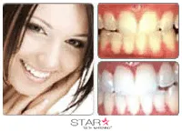 33308 star white teeth whitening take home kit