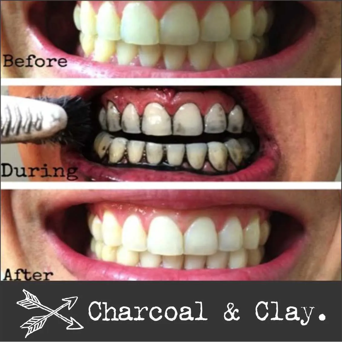 33312 activated charcoal teeth whitening before after