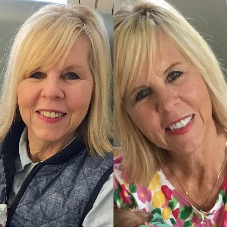 33315 teeth whitening results