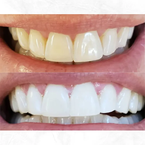 33324 berkeley teeth whitening before after