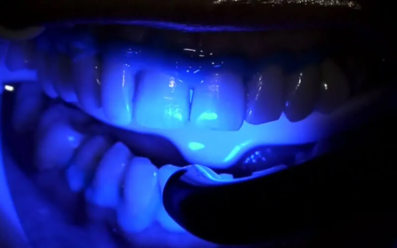 33324 professional teeth whitening