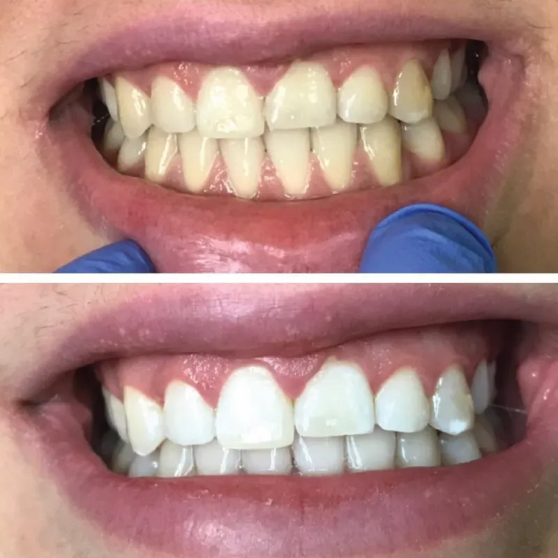 33324 teeth whitening care