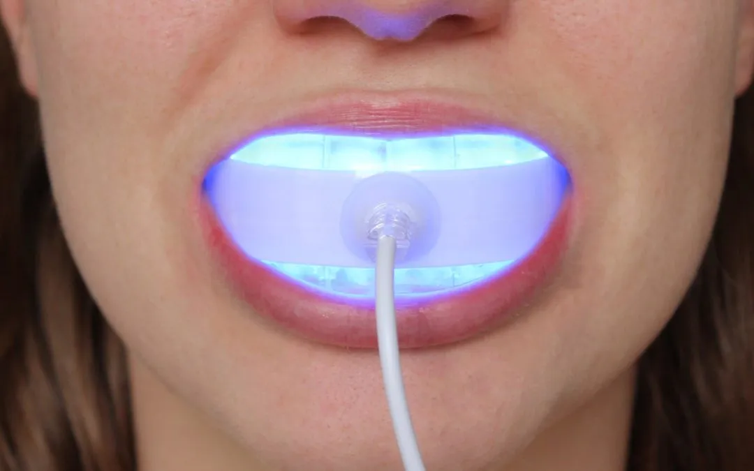 33325 using teeth whitening kit