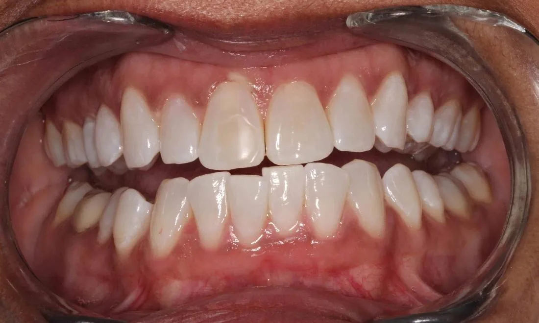 33326 hydrogen peroxide teeth