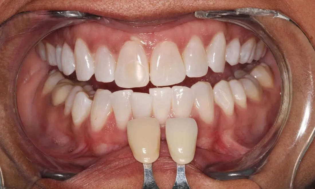 33326 teeth whitening products