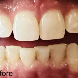 33327 types of teeth whitening