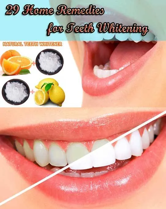 33329 custom tray teeth whitening