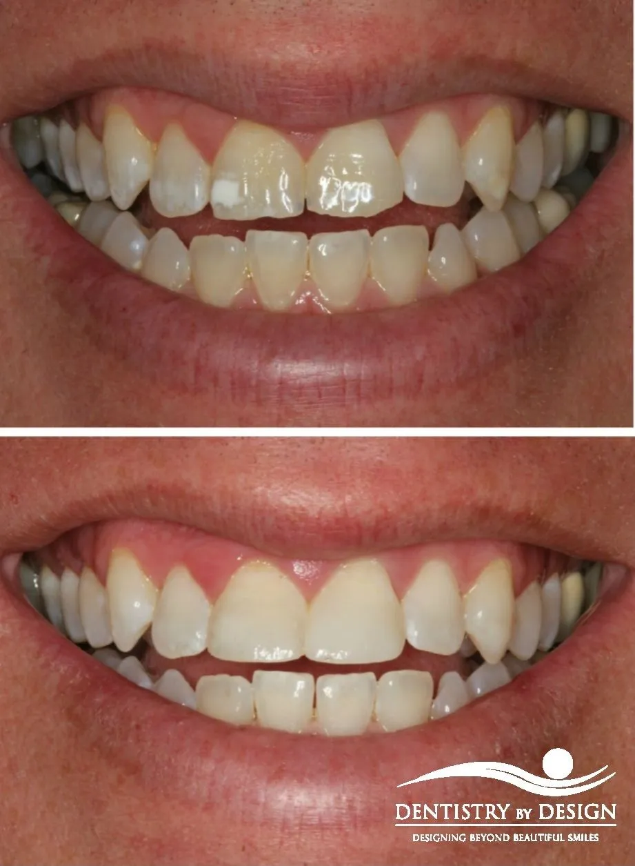 /img/33341-teeth-whitening-morayfield-dental-checkup.webp