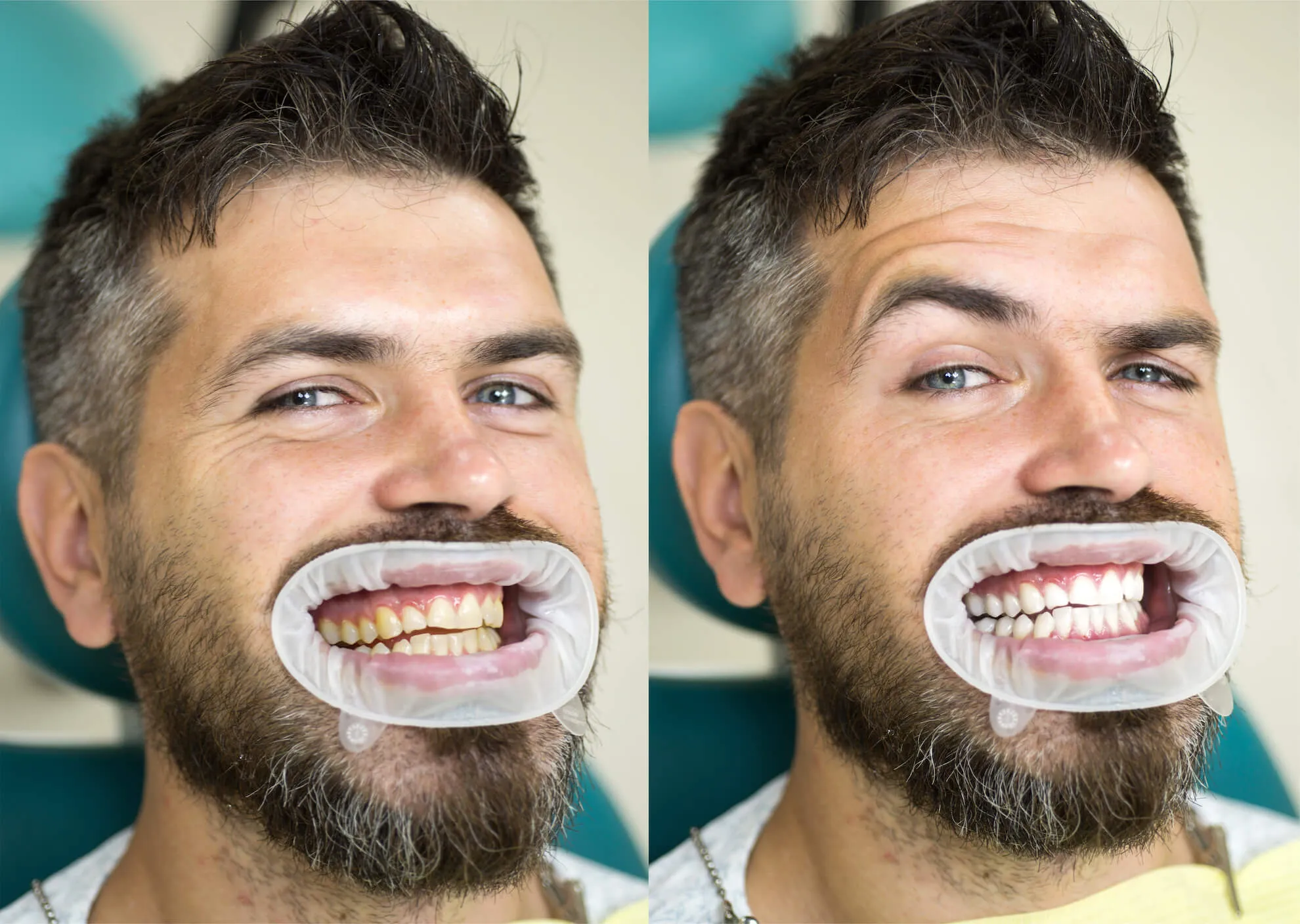 33341 teeth whitening morayfield procedure