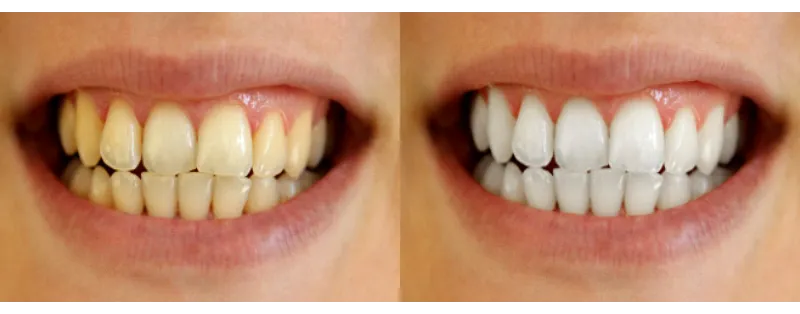 33347 zoom teeth whitening uk 1