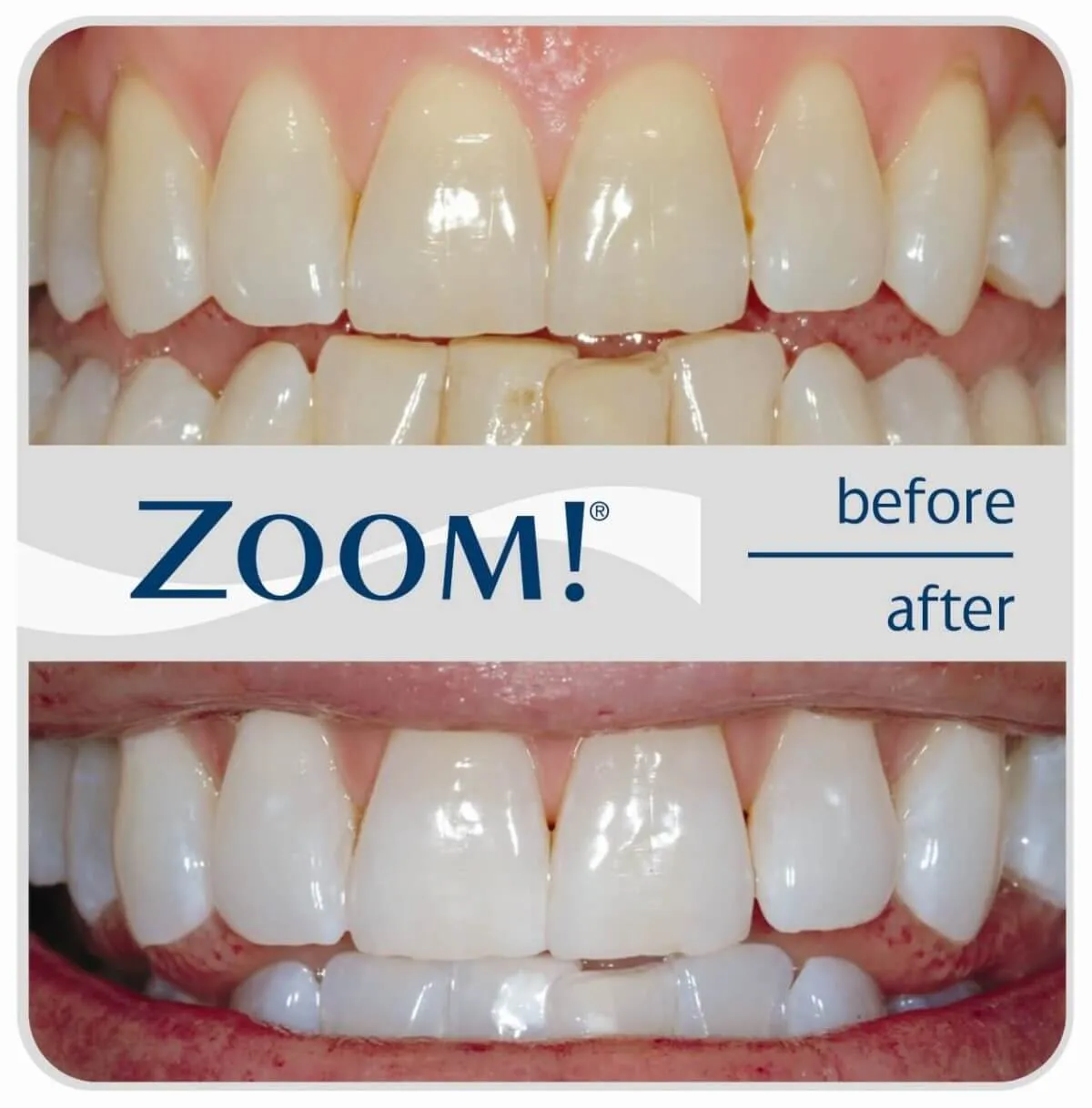 33347 zoom teeth whitening uk 3
