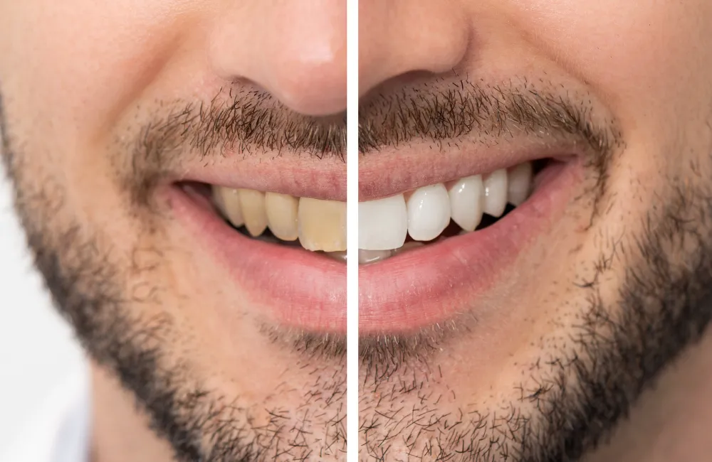 33348 gum irritation