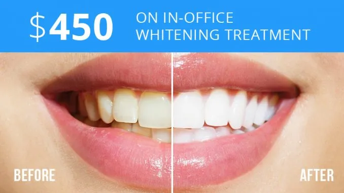 33355 home teeth whitening kits