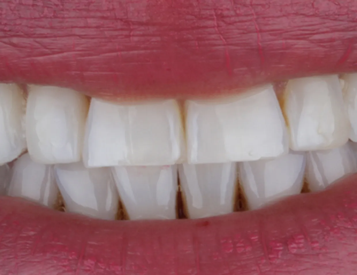 33362 laser teeth whitening 5