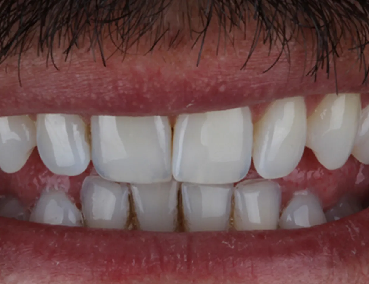 /img/33362-laser-teeth-whitening-6.webp