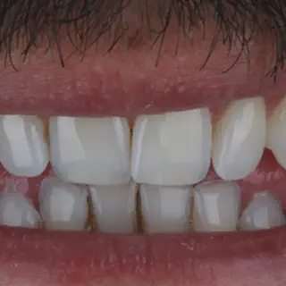 /img/33362-laser-teeth-whitening-6.webp
