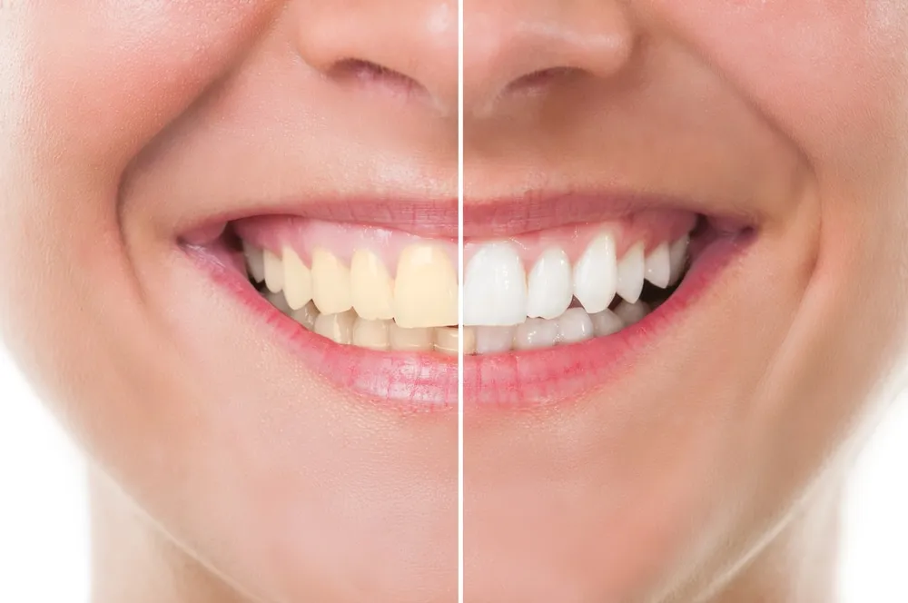 33364 at home teeth whitening