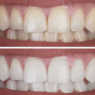 /img/33364-teeth-whitening-options-nyc.webp