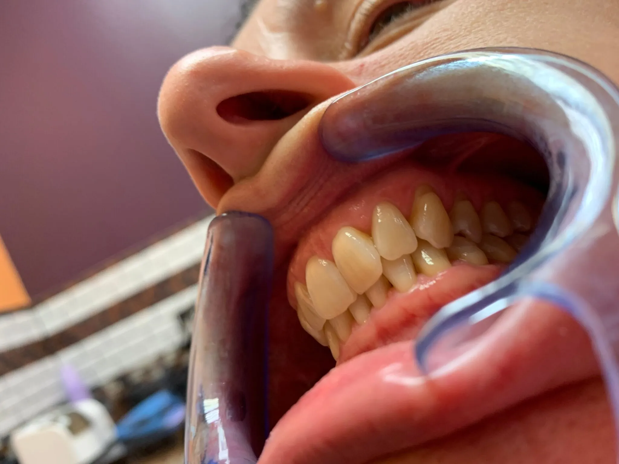 33365 in office teeth whitening